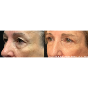 body-revolution-wellness-accutite-morpheus-prime-before-after-image-w
