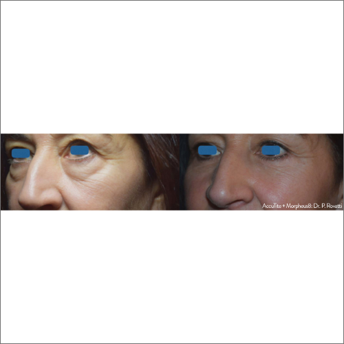 body-revolution-wellness-accutite-morpheus8-before-after-image-a-z