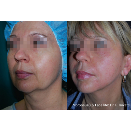 body-revolution-wellness-morpheus-facetite-before-after-image-a-q