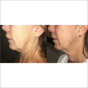 body-revolution-wellness-morpheus8-before-after-image-a
