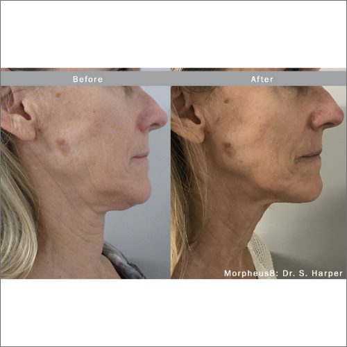 body-revolution-wellness-morpheus8-before-after-image-a-b