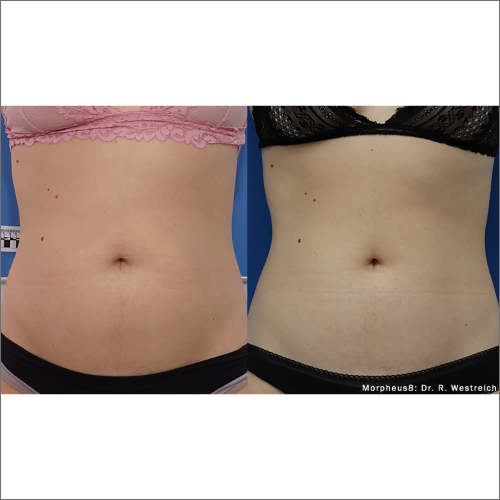 body-revolution-wellness-morpheus8-before-after-image-a-f