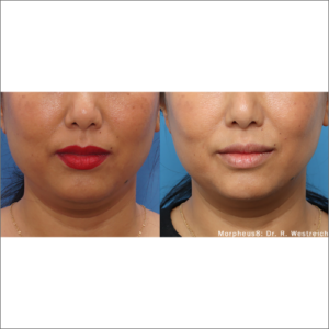 body-revolution-wellness-morpheus8-before-after image-a-g