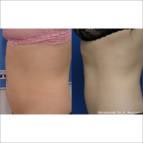 body-revolution-wellness-morpheus8-before-after-image-a-h