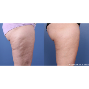 body-revolution-wellness-morpheus8-before-after-image-a-m
