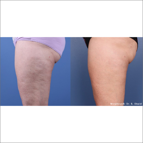 body-revolution-wellness-morpheus8-before-after-image-a-n