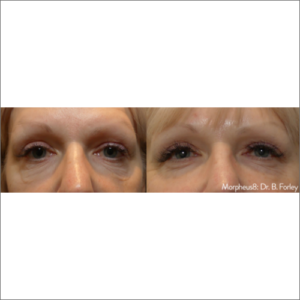 body-revolution-wellness-morpheus8-before-after-image-a-p