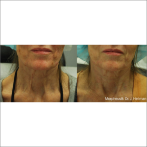 body-revolution-wellness-morpheus8-before-after-image-a-r