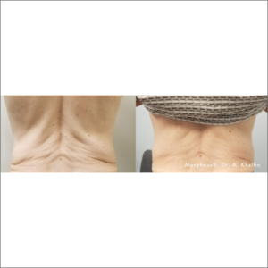 body-revolution-wellness-morpheus8-before-after-image-a-s