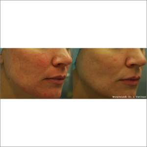 body-revolution-wellness-morpheus8-before-after-image-a-x