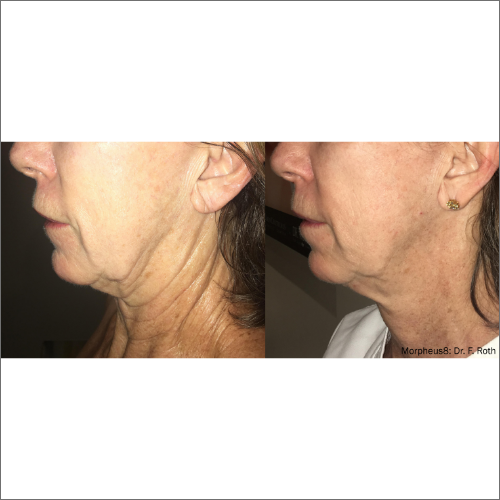 body-revolution-wellness-morpheus8-before-after-image-a