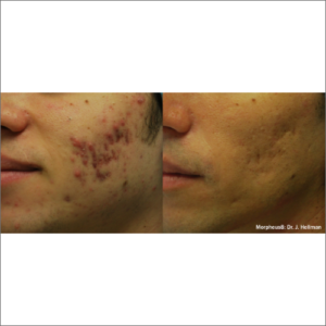 body-revolution-wellness-morpheus8-before-after-image-h