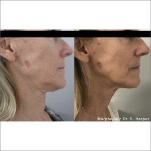 body-revolution-wellness-morpheus8-before-after-image-s
