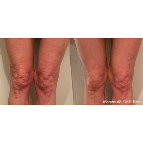 body-revolution-wellness-morpheus8-before-after-image-t