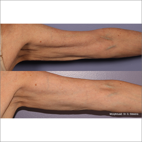 body-revolution-wellness-morphues8-before-after-image-a-c